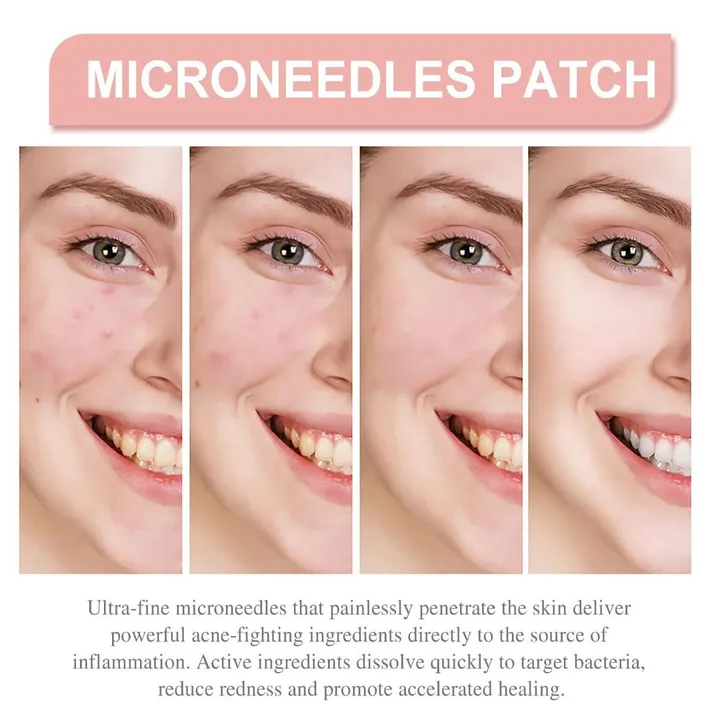 Hydrocolloid Acne Patch 144 Pcs – photo 3
